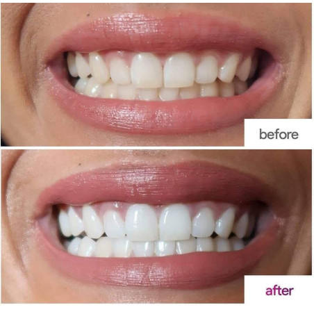 معجون تبييض الأسنان البنفسجي